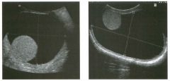 Tra nsverse views of the scrotu m i n two patients with the same
a bnormal ity.
1 . Is the location of the testis more typical in the first or in the second image?
2. What is the likely cause of this condition?
3. What would you expect to see at incre