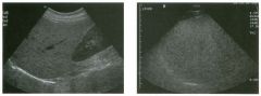 lon g itudinal views of the right upper quadrant in two patients.
1 . List the echogenicity of liver, kidney, spleen, and pancreas from most to least echogenic.
2. What is the most common cause of the abnormalities shown in these images?
3. In the firs