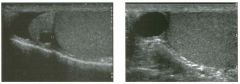 lon g itudinal views of the scrotu m i n two patients.
l . Do these patients have anything in common?
2. Is this abnormality likely to be palpable?
3. Is this abnormality commonly or uncommonly seen on ultrasound?
4. What does this lesion contain?