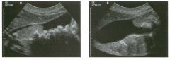 Long itu d i nal views of the g a l l bladder.
1 . What is the differential diagnosis based only on the first image?
2. How does the second image help in establishing the diagnosis?
3. How can follow-up studies help?