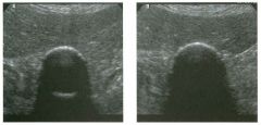 Transverse views of the gallbl adder.
1 . What two conditions are most likely to produce this sonographic appearance?
2 . Does the nature of the shadowing help in favoring one of the two possibilities?
3. What other imaging examination could be used to