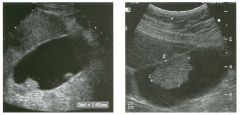 Views of the g a l l bladder in two patients.
1 . What is the differential diagnosis?
2 . How does color Doppler assist in the differential diagnosis?
3. What else helps in narrowing the differential diagnosis?
4. What is the treatment of this lesion?