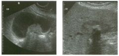 Views of the g a l l bladder in two patients.
1 . Which image is more typical of this condition?
2. Is this abnormality more common in women or in men?
3. What predisposes to this condition?
4. Is this condition more commonly seen in elderly or ill yo