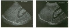 Two views of the liver.
1 . What type of transducer was used to scan the liver in the first image?
2. What type of transducer was used to scan the liver in the second image?
3. What is the advantage of the first transducer?
4. What is the advantage of