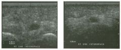 Tra nsverse views of the second and third web space of the toes.
1. From what anatomic structure do these lesions arise?
2. What is the most common location of these lesions?
3. Are these lesions more common in men or in women?
4. Are they benign or m