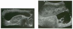 Views of renal transp la nts i n two patients.
1 . What is the abnormal finding?
2. What is the differential diagnosis?
3. How good is ultrasound at diagnosing transplant rejection?
4. Where do posttransplant urinomas usually occur?