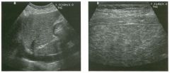 Two views of the l iver.
1 . What types of transducers have been used?
2. Which transducer shows the abnormality best?
3. What is the differential diagnosis?
4. Is there a role for Doppler sonography in establishing this diagnosis?