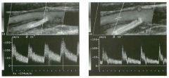 Lon g itudinal color Doppler views and pulsed Doppler waveforms from
the carotid bifurcation. (See color plates.)
1 . Identify the internal and external carotid arteries.
2 . Do both vessels appear normal?
3. If this patient had a history of transient