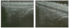 long itud i n a l views of the patellar tendon.
1 . Which view shows a normal patellar tendon?
2. What is the differential diagnosis for a hypoechoic tendon?
3. Are nerves more or less echogenic than tendons?
4. Does ultrasound demonstrate the interna