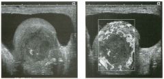 Transverse grey-scale and power Doppler views of the testis.
1 . What are the major findings in this case?
2. Are these abnormalities most likely due to a neoplastic or nonneoplastic etiology?
3. Does the ag