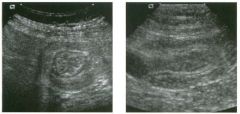 Views of the left mid abdome n .
1 . Describe the abnormality shown on these images.
2. What is the differential diagnosis?
3 . Is this abnormality more common in children or in adults?
4. Does color Doppler have a role in evaluating patients with thi