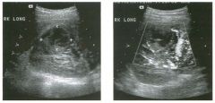 Longitudi nal g rey-sca le and color Doppler view of the right kidney.
1 . What is the sonographic abnormality seen in these images?
2 . If this patient had pyuria, what would be the most likely diagnosis?
3. If this patient had hematuria, what would b