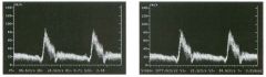 Pulsed Doppler waveform with two s pectral measurements.
1 . What is being measured in the first unage?
2 . Is this measurement dependent on the Doppler angle?
3 . What is being measured in the second image?
4 . Is this measurement dependent on the Do