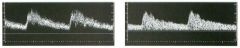 Pu lsed Doppler waveforms from two a rteries.
1. Would you characterize these waveforms as high or low resistance?
2. What is the difference in these two waveforms?
3. Which of these waveforms is likely to have come from a normal internal carotid arter