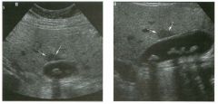 Two views of the liver.
1 . Describe the abnormality indicated by the arrows.
2. Is this condition seen more often on ultrasound or on CT?
3. Where else is this abnormality typically seen?
4. What can be done to help increase diagnostic confidence?