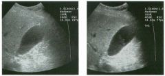 Two views of the g a l l b l adder.
1 . What technique was used to allow the gallbladder sludge to be better seen on the second image?
2 . Is this technique theoretically more important in thin patients or in obese patients?
3. Is this technique theore