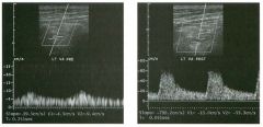 Wavefo rms of the vertebral a rtery taken 1 day apart.
1 . Which of the waveforms is abnormal?
2. What is the Significance of this waveform abnormality?
3. What would you consider if this waveform abnormality were seen in multiple abdominal and
periph