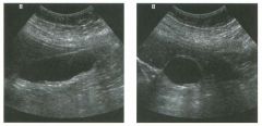 Lon g itudinal and tran sverse views of the gallbladder.
1 . If this patient had intermittent bouts of severe right upper quadrant pain lasting a few hours, would a
cholecystectomy be uldicated?
2. What is the major sonographic difference between stone
