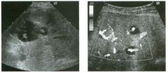 G rey-scale and color Doppler views of the l iver. (See color pl ates.)
1 . What sonographic sign is demonstrated on these scans?
2. What disease causes this sign?
3. To what is tl1is patient predisposed?
4. What other organ is usually affected with t