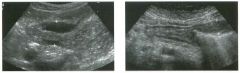 Views of the stomach i n two patients.
1. What is the normal gut signature on sonography?
2. What abnormality is present in both linages?
3 . What is the differential diagnosis?
4. What would be an appropriate next test?