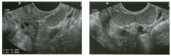 Longitudinal transvaginal views of the left ad nexa. The patient has a
remote history of a motor vehicle accident.
1. Describe the abnormality.
2 . Can this abnormality be related to the patient's history?
3. What else should be considered in the diff