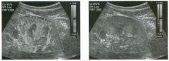 Color Doppler views of the kidney. (See color plates .)
1. Why is renal cortical flow better shown on the first image than on the second image?
2. Is the Doppler control that is responsible for the differences shown in the images a preprocessing or
a p