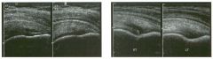 Two sets of dual longitudinal i mages of the rotator cuff i n d ifferent
patients with right shoulder pain.
1. What is the diagnosis?
2 . Where does this abnormality most often occur?
3. Does this abnormality usually compress with transducer pressure?