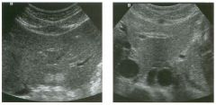 Transverse views of the left l o be of the l iver and of the proximal abdom inal aorta in two
patients.
1 . What artifact is present on both of these images?
2 . What causes this artifact?
3. How can this artifact be eliminated?
4. Does sound travel 