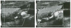 Longitudina l views of the i nternal carotid artery. (See color pl ates.)
1 . Based on the diff erent Doppler angle in the two images above, in which image would you expect the
frequency shifts from the internal carotid artery to be higher?
2 . Why is 