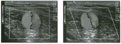 Transverse color Doppler views of the outflow vei n from a d i a lysis fistula.
(See color plates.)
1 . Is aliaSing present on these views?
2 . Explain the color assignment on these linages .
3. Why did the distribution o f red and blue color assignme