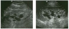 longitudinal views of the kid n ey in two patients.
1. Describe the abnormality in these kidneys.
2 . What are the two major conditions that should be considered in the differential diagnosis?
3. How is it possible to distinguish these conditions?
4. 