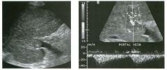 Longitudinal grey-scale view of and color Doppler view and pulsed
Doppler waveform from the portal vein. (See color plates.)
1 . What is the significance of an expanded portal vein lumen filled with echogenic material?
2. What is the significance of th