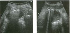 Transverse views of the g a l l bladder.
1 . Describe the abnormal findings.
2. Is this abnormality more common in men or in women?
3. Is this a medical or a surgical condition?
4. What other gallbladder abnormalities can sinmlate this condition?