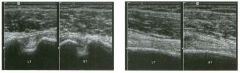 Dual transverse and longitudinal views of the left and rig ht biceps
tendon groove.
1 . Describe the abnormality.
2. Is this diagnosis difficult to make clinically?
3. Which head of the biceps muscle is involved?
4. Are there other conditions that sh