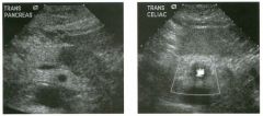 Transverse views of the pancreas a n d of the celiac axis. (See color
plates.)
1 . Describe the abnormalities .
2 . Should this patient see a surgeon?
3. What other sites should be evaluated sonographically while the patient is being scanned?
4. What