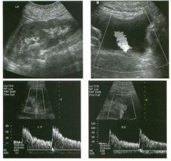 Pregnant patient with a left u reteral stone (the same patient shown i n
case 27). T h e figures include a longitudinal view of the left kid n ey,
transverse color Doppler view of the bladder, and pu lsed Doppler
waveforms from the left and rig ht kidn