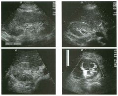 Lo ngitudinal and two transverse g rey-sca le views and transverse power
Doppler view of the kid ney in a patient with flank pain.
1 . Describe the abnormalities.
2. How good is ultrasound at malting this diagnosis?
3. What is the role of ultrasound i