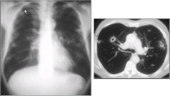 Wegener's granulomatosis
Autoimmune condition involving the upper and lower respiratory tract and kidneys
Vasculitis involving the medium-sized vessels, with formation of granulomas and necrosis of lung parenchyma 

Lung abscess: development of a cavi