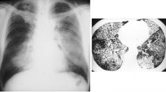 Pulmonary alveolar proteinosis
CXR:
Bilateral symmetric opacity in a "bat wing" distribution
May be areas of course reticulation
Treatment: bronchoalveolar lavage 

CT: crazy paving
Smoothly thickened interlobular septa within areas of GGO 
Panlob