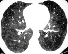 Hypersensitivity pneumonitis(extrinsic allergic alveolitis)

Case findings:
Subacute: MC fine reticular or reticulonodular pattern involving both lungs, centrilobular GG nodules
CT: numerous centrilobular, peribronchiolar, indistinct nodular opacitie