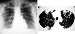 Chronic eosinophilic pneumonia

Case findings:
CXR: photographic negative of pulmonary edema  peripheral infiltrate (in the outer 2/3 of the lung) 
Peripheral infiltrates are MC in UL and occur bilaterally. About 20% patients present migratory infilt