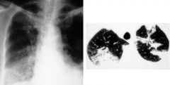 Bronchiolitis obliterans organizing pneumonia (BOOP)

Case findings:
Patchy consolidation may be fleeting and migratory 
GGO is associated with the presence of alveolitis
Consolidations are MC in subpleural regions 

DDX:
Chronic eosinophilic pneu