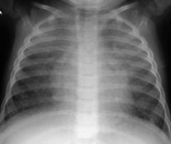 Langerhans' cell histiocytosis 
Case findings
CXR: ill-defined nodules (2-10mm), reticulonodular opacities, cysts MC in UL
CT: combination of cysts and nodules 

Male smokers
Upper lobe, irregular variable cysts with nodules (may undergo cavitation)