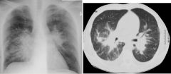 Kaposi’s sarcoma

Case findings:
CXR: central air-space opacities involving the left middle and bilateral lower lung zones 
CT: bilateral peri-bronchovascular bundle opacities radiating from the hila with a nodular component

DDX:
Kaposi’s sarcoma 