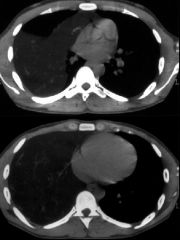 Thymolipoma
Case findings:
CXR: 
Large well-defined right anterior inferior mediastinal mass that conforms to the shape of the adjacent mediastinum
CT:
Mass containing fat and soft tissue
Little mass on mediastinum, despite large size

DDX:
Lipom