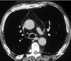 Mediastinal lipomatosis
Case findings:
CXR: mediastinum is widened
CT:
Interval development of a right pleural effusion
Large amount of fat within the mediastinum and in the epicardial fat pads

Associated with:
Obesity
Steroids: exogenous or end