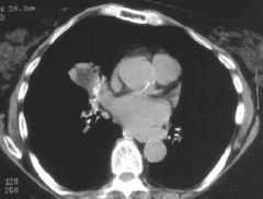 Lipoid pneumonia 
Case findings:
Bilateral areas of consolidation of fatty density within the posterolateral segment of RML and lingula

Results from aspiration of mineral, vegetable or animal oil