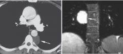 Bronchogenic cyst
Case findings:
CXR: 
Round mass (arrow) that displaces the right primary bronchus superiorly 
RML pneumonia and pleural effusion
CT: 
Cyst with uniform fluid attenuation and an imperceptible wall

Cystic mediastinal masses
Conge