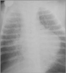 Cor triatriatum (“heart with three atria”)
Case findings:
XR: Normal heart size with RV enlargement
MR: Membrane at the atrial level with high signal from slow flow

Rare congenital anomaly due to a failure of the common pulmonary vein to incorporat
