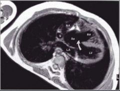 Tetralogy of Fallot
Components of tetralogy of Fallot:
Pulmonic stenosis
Result of infundibular musculature hypertrophy (above crista supraventricularis and below pulmonary valve)
VSD
Overriding aorta
Right ventricular hypertrophy

Pulmonary atres